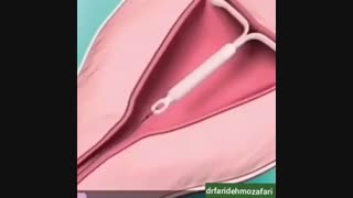 آی یو دی چگونه انجام می شود؟