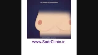 تشخیص سرطان سینه