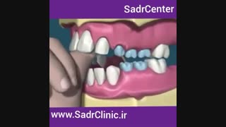 عوارض مکیدن انگشت