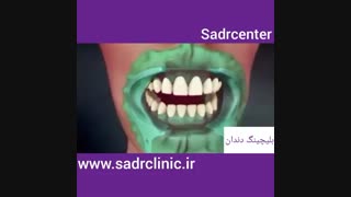 بلیچینگ دندان