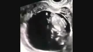 سونوگرافی بارداری