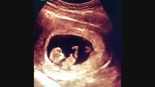 سونوگرافی بارداری