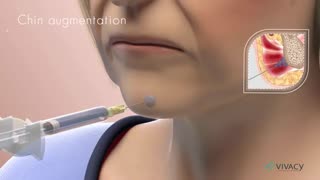 آموزش تزریق فیلر به چانه
