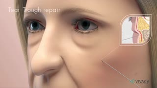 آموزش تزریق ژل فیلر به زیر چشم