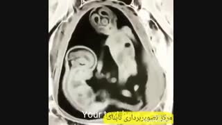 سونوگرافی سه بعدی