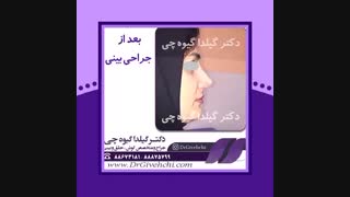نمونه کار جراحی بینی استخوانی