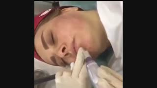 میکرونیدلینگ صورت