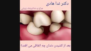 بعد از کشیدن دندان چه اتفاقی می افتد؟