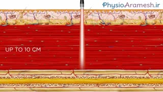 لیزر درمانی نقاط ماشه ای