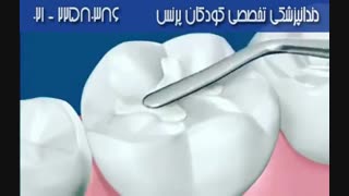 قبل از بحرانی شدن وضعیت دندان, نسبت به ترمیم دندان اقدام کنید