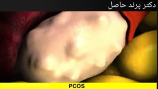 شکل تخمدان پلی کیستیک !