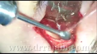 تومور داخل استخوان کاسه چشم