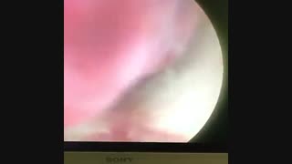 علت خونریزی رحم بعد از یائسگی