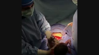 لحظه تولد (زایمان سزارین )