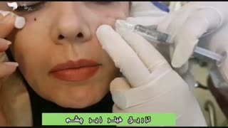 تزریق ژل زیرچشم