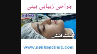 رینوپلاستی در کلینیک اشکان