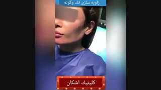 تزریق ژل به گونه و صورت