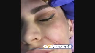بلفاروپلاستی با پلکسر
