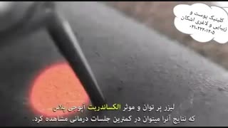 لیزر موهای زائد با دستگاه آپوجی پلاس