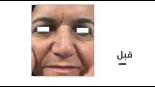 بلفاروپلاستی پلک پایین با پلکسر