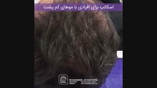 اسکالپ روی سر افرادی که کم پشتی مو دارند