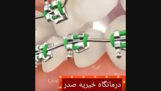 مراقبت های ارتودنسی دندان