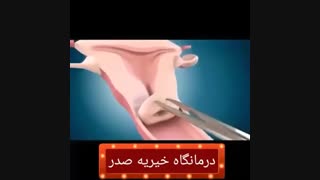 نحوه گذاشتن iud