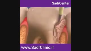 جرم گیرى باعث بهبود بیماریهاى لثه مى شود