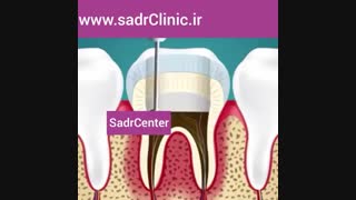 عصب کشی و ترمیم دندان !!!!