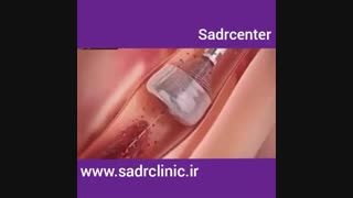 برداشتن لخته خون از رگ با انژیوگرافی