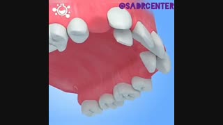 برهم ریختگی دندان ها