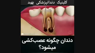 عصب کشی دندان چگونه است؟