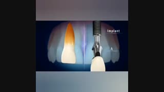 ایمپلنت دندان چگونه است؟