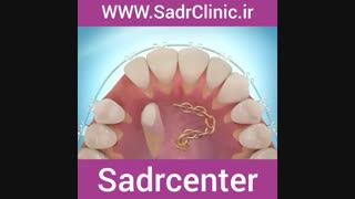 ارتودنسی دندان نیش