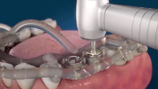 کاشت دیجیتالی دندان در کوتاه ترین زمان | کلینیک مدرن