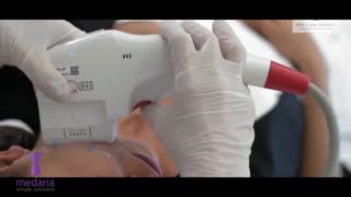 هایفو تنها تکنولوژی غیر جراحی جایگزین لیفت صورت