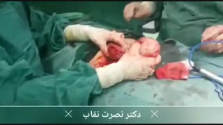عمل جراحی میومکتومی (برداشت فیبروم رحم)