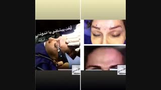 لیفت پیشانی