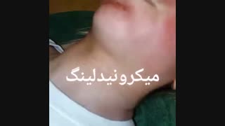 میکرونیدلینگ - کلینیک زیبایی پری سیما - 22807060