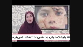 کرم ضد لک و روشن کننده 09120852440 جرمگیری