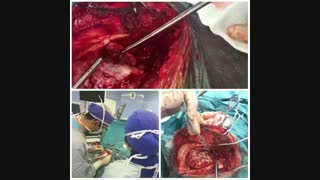 عمل جراحی پیچیده تومور مغزی با درگیری چشم /  دکتر مسعود اصغری نوسری