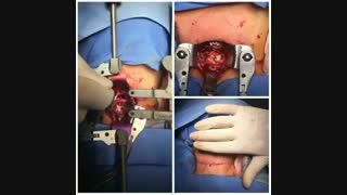 عمل جراحی ٣دیسک گردن / دکتر مسعود اصغری نوسری