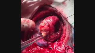 عمل جراحی تومور بسیار بزرگ مننژیوم / دکتر مسعود اصغری نوسری