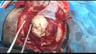 خارج کردن کامل تومور بسیار بزرگ گلیوم / دکتر مسعود اصغری نوسری