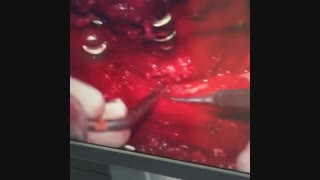 عمل جراحی بیمار با سابقه ۳بار جراحی دیسک کمر / دکتر مسعود اصغری نوسری