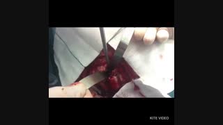 عمل جراحی اورژانس تخلیه خونریزی بسیار وسیع مغزی / دکتر مسعود اصغری نوسری