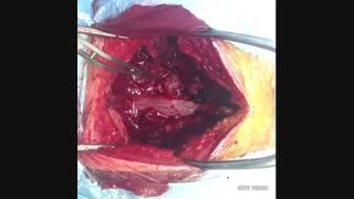 عمل جراحی تومور بسیار بزرگ نخاع / دکتر مسعود اصغری نوسری