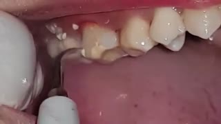 جرمگیری دندان -دکترمجیدقیاسی دندانپزشک زیبایی درمشهد