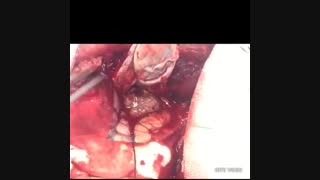 خارج کردن کامل تومور گلیوم مغزی / دکتر مسعود اصغری نوسری