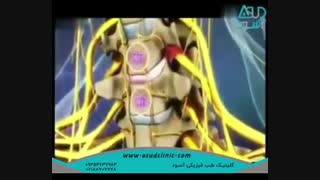 دیسک گردن| کلینیک طب فیزیکی و توانبخشی آسود
